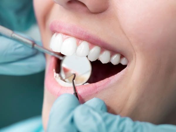 Dental Deep Cleaning After Care